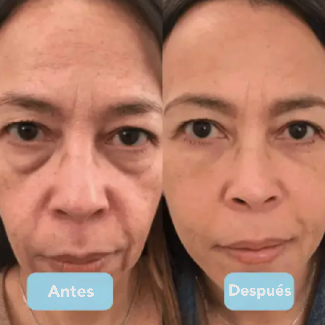 TENSY 3-en-1 Escultor Facial LED